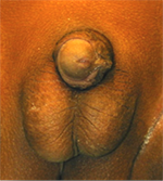 an example of penis torsion