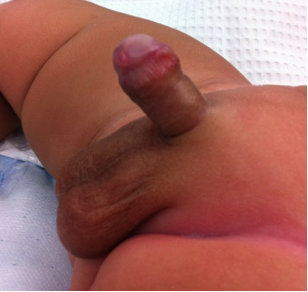 a child with penis torsion
